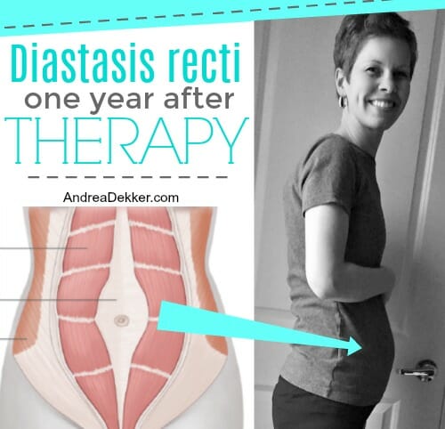 Diastasis Recti Physical Therapy Covered By Insurance