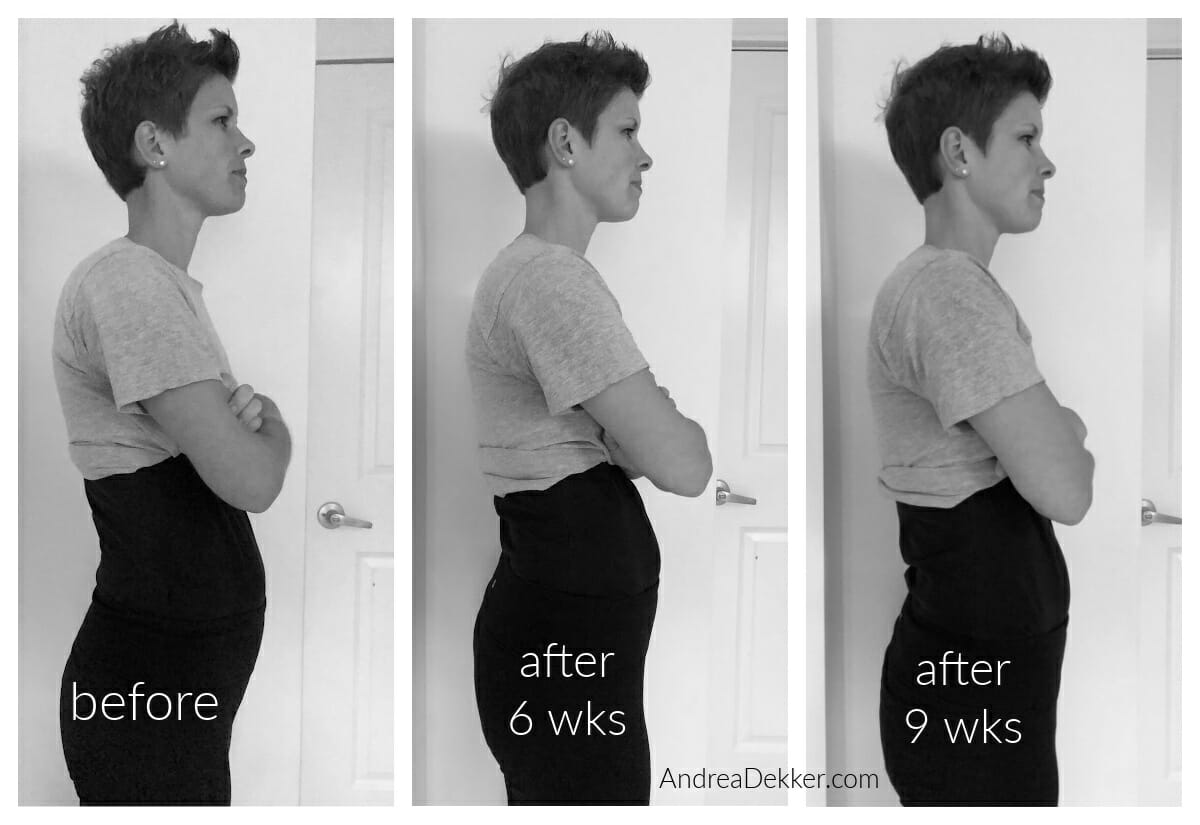 diastasis recti healed